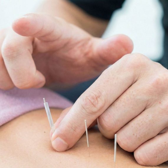 dry needling 2